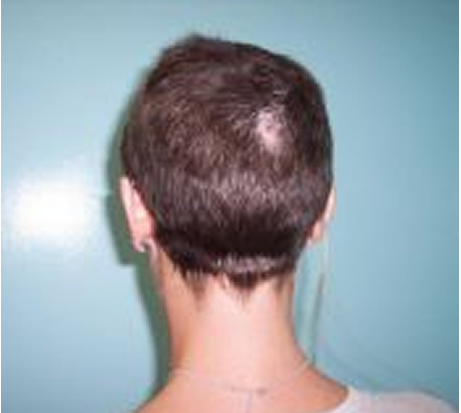 alopecia